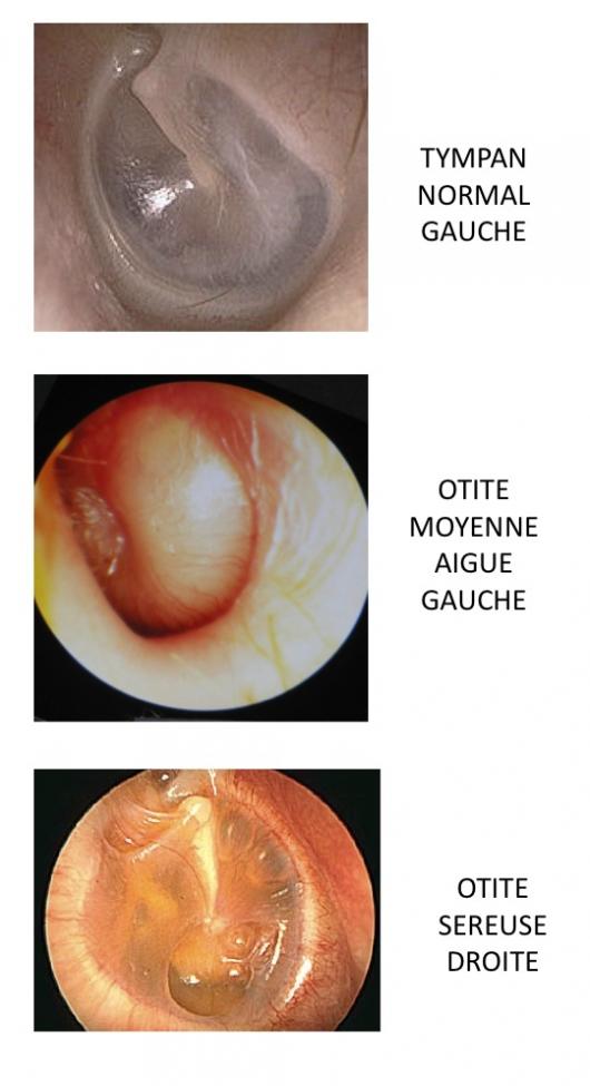 Pathologies du tympan, perforation, rétraction et cholestéatome 